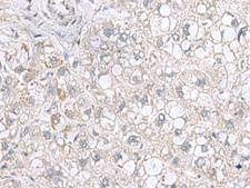 STK32A Antibody - Immunohistochemistry of paraffin-embedded Human liver cancer tissue  using STK32A Polyclonal Antibody at dilution of 1:95(×200)