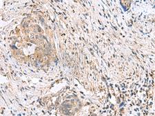 STK32A Antibody - Immunohistochemistry of paraffin-embedded Human cervical cancer tissue  using STK32A Polyclonal Antibody at dilution of 1:90(×200)