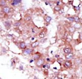 STK33 Antibody - Formalin-fixed and paraffin-embedded human cancer tissue reacted with the primary antibody, which was peroxidase-conjugated to the secondary antibody, followed by DAB staining. This data demonstrates the use of this antibody for immunohistochemistry; clinical relevance has not been evaluated. BC = breast carcinoma; HC = hepatocarcinoma.