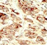 STK35 Antibody - Formalin-fixed and paraffin-embedded human cancer tissue reacted with the primary antibody, which was peroxidase-conjugated to the secondary antibody, followed by DAB staining. This data demonstrates the use of this antibody for immunohistochemistry; clinical relevance has not been evaluated. BC = breast carcinoma; HC = hepatocarcinoma.