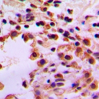 STK36 Antibody - Immunohistochemical analysis of STK36 staining in human lung cancer formalin fixed paraffin embedded tissue section. The section was pre-treated using heat mediated antigen retrieval with sodium citrate buffer (pH 6.0). The section was then incubated with the antibody at room temperature and detected using an HRP conjugated compact polymer system. DAB was used as the chromogen. The section was then counterstained with haematoxylin and mounted with DPX.