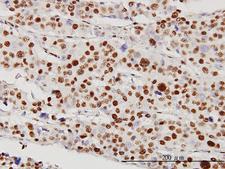 STK38 Antibody - Immunoperoxidase of monoclonal antibody to STK38 on formalin-fixed paraffin-embedded human malignant lymphoma, diffuse large B tissue [antibody concentration 5 ug/ml].