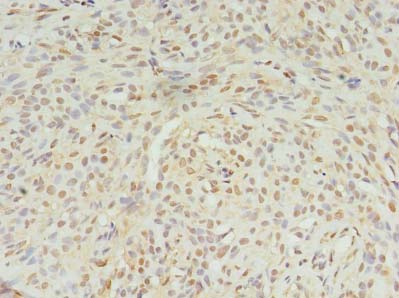 STK38L / NDR2 Antibody - Immunohistochemistry of paraffin-embedded human breast cancer using antibody at dilution of 1:100.