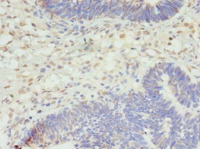 STK38L / NDR2 Antibody - Immunohistochemistry of paraffin-embedded human ovarian cancer using antibody-PA896491LA01HU at dilution of 1:100.