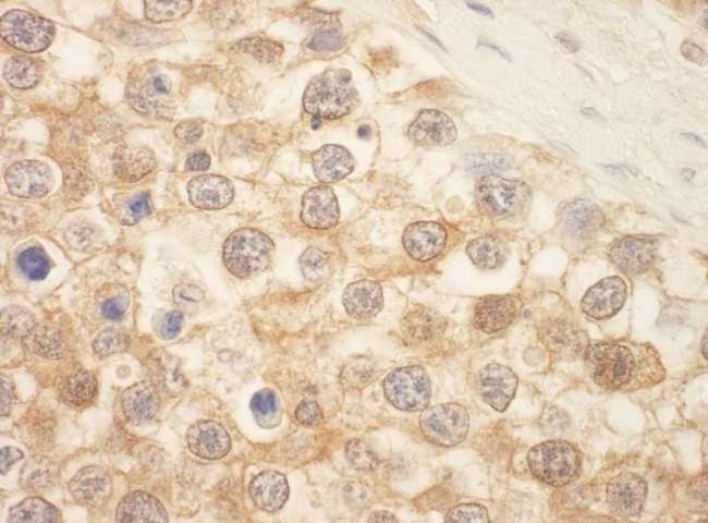 STK39 / SPAK Antibody - Detection of Human SPAK by Immunohistochemistry. Sample: FFPE section of human testicular seminoma. Antibody: Affinity purified rabbit anti-SPAK used at a dilution of 1:200 (1 ug/ml). Detection: DAB.