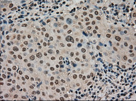 STK39 / SPAK Antibody - IHC of paraffin-embedded Adenocarcinoma of breast tissue using anti-STK39 mouse monoclonal antibody. (Dilution 1:50).