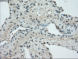 STK39 / SPAK Antibody - IHC of paraffin-embedded Carcinoma of lung tissue using anti-STK39 mouse monoclonal antibody. (Dilution 1:50).