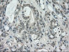 STK39 / SPAK Antibody - IHC of paraffin-embedded Adenocarcinoma of colon tissue using anti-STK39 mouse monoclonal antibody. (Dilution 1:50).
