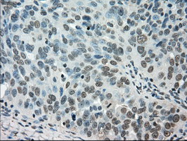 STK39 / SPAK Antibody - IHC of paraffin-embedded Adenocarcinoma of ovary tissue using anti-STK39 mouse monoclonal antibody. (Dilution 1:50).
