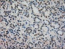 STK39 / SPAK Antibody - Immunohistochemical staining of paraffin-embedded Carcinoma of thyroid tissue using anti-STK39 mouse monoclonal antibody. (Dilution 1:50).