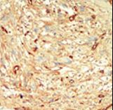 STK4 Antibody - Formalin-fixed and paraffin-embedded human cancer tissue reacted with the primary antibody, which was peroxidase-conjugated to the secondary antibody, followed by DAB staining. This data demonstrates the use of this antibody for immunohistochemistry; clinical relevance has not been evaluated. BC = breast carcinoma; HC = hepatocarcinoma.
