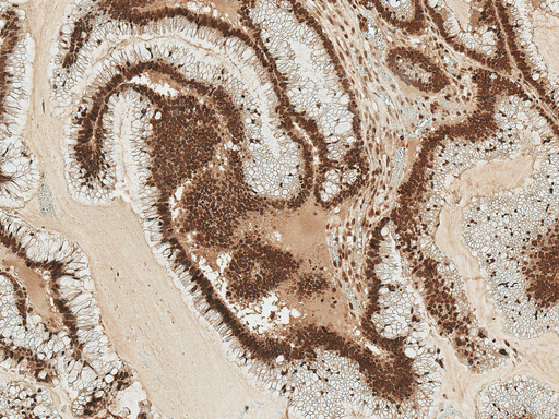 STK4 Antibody - Immunohistochemistry analysis using Rabbit Anti-STK4 Polyclonal Antibody. Tissue: Colon Cancer. Species: Human. Fixation: Formalin Fixed Paraffin-Embedded. Primary Antibody: Rabbit Anti-STK4 Polyclonal Antibody  at 1:50 for 30 min at RT. Counterstain: Hematoxylin. Magnification: 10X. HRP-DAB Detection.