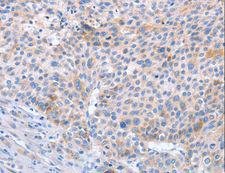 STK4 Antibody - Immunohistochemistry of paraffin-embedded Human liver cancer using STK3/STK4 Polyclonal Antibody at dilution of 1:70.