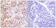 STK4 Antibody - P-peptide - + Immunohistochemistry analysis of paraffin-embedded human liver carcinoma tissue using Mst1/2 (Phospho-Thr183) antibody.