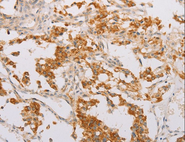 STK40 Antibody - Immunohistochemistry of paraffin-embedded Human lung cancer using STK40 Polyclonal Antibody at dilution of 1:40.
