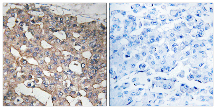 STMN1 / Stathmin / LAG Antibody - Immunohistochemistry analysis of paraffin-embedded human breast carcinoma tissue, using STMN1 Antibody. The picture on the right is blocked with the synthesized peptide.