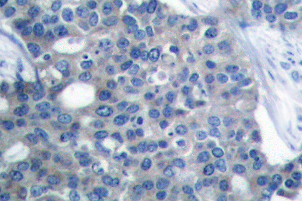 STMN1 / Stathmin / LAG Antibody - IHC of Op18 (A18) pAb in paraffin-embedded human breast carcinoma tissue.