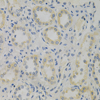 STMN1 / Stathmin / LAG Antibody - Immunohistochemistry of paraffin-embedded human kidney cancer using STMN1 Antibody at dilution of 1:200 (40x lens).