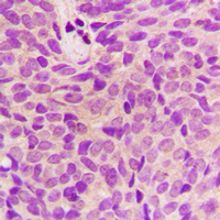 STMN1 / Stathmin / LAG Antibody - Immunohistochemical analysis of STMN1 staining in human breast cancer formalin fixed paraffin embedded tissue section. The section was pre-treated using heat mediated antigen retrieval with sodium citrate buffer (pH 6.0). The section was then incubated with the antibody at room temperature and detected using an HRP-conjugated compact polymer system. DAB was used as the chromogen. The section was then counterstained with hematoxylin and mounted with DPX.