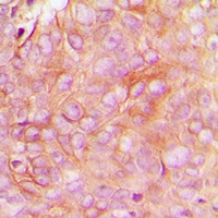 STMN1 / Stathmin / LAG Antibody - Immunohistochemical analysis of STMN1 (pS16) staining in human breast cancer formalin fixed paraffin embedded tissue section. The section was pre-treated using heat mediated antigen retrieval with sodium citrate buffer (pH 6.0). The section was then incubated with the antibody at room temperature and detected using an HRP polymer system. DAB was used as the chromogen. The section was then counterstained with hematoxylin and mounted with DPX.