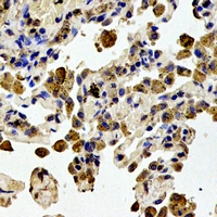 STMN1 / Stathmin / LAG Antibody - Immunohistochemical analysis of STMN1 (pS38) staining in human lung cancer formalin fixed paraffin embedded tissue section. The section was pre-treated using heat mediated antigen retrieval with sodium citrate buffer (pH 6.0). The section was then incubated with the antibody at room temperature and detected using an HRP polymer system. DAB was used as the chromogen. The section was then counterstained with hematoxylin and mounted with DPX.