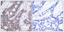 STMN1 / Stathmin / LAG Antibody - Immunohistochemistry analysis of paraffin-embedded human breast carcinoma, using Stathmin 1 (Phospho-Ser15) Antibody. The picture on the right is blocked with the phospho peptide.