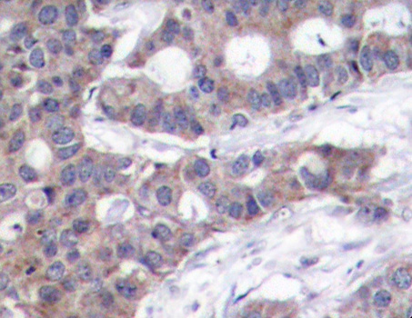 STMN1 / Stathmin / LAG Antibody - Immunohistochemical analysis of paraffin-embedded human breast carcinoma tissue.