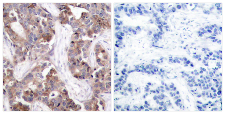 STMN1 / Stathmin / LAG Antibody - Immunohistochemistry analysis of paraffin-embedded human breast carcinoma, using Stathmin 1 (Phospho-Ser24) Antibody. The picture on the right is blocked with the phospho peptide.