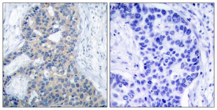 STMN1 / Stathmin / LAG Antibody - Immunohistochemistry analysis of paraffin-embedded human breast carcinoma, using Stathmin 1 (Phospho-Ser37) Antibody. The picture on the right is blocked with the phospho peptide.