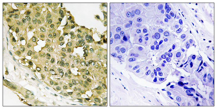 STMN1 / Stathmin / LAG Antibody - Immunohistochemistry analysis of paraffin-embedded human breast carcinoma, using STMN1 (Phospho-Ser62) Antibody. The picture on the right is blocked with the phospho peptide.