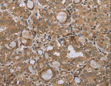 STMN2 + STMN3 + STMN4 Antibody - Immunohistochemistry of paraffin-embedded Human ovarian cancer using STMN2/STMN3/STMN4 Polyclonal Antibody at dilution of 1:45.