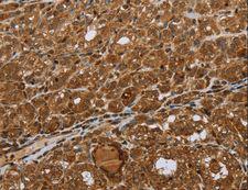 STMN2 + STMN3 + STMN4 Antibody - Immunohistochemistry of paraffin-embedded Human thyroid cancer using STMN2/STMN3/STMN4 Polyclonal Antibody at dilution of 1:45.