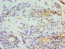 STOM / Stomatin Antibody - Immunohistochemistry of paraffin-embedded human breast cancer using antibody at 1:100 dilution.
