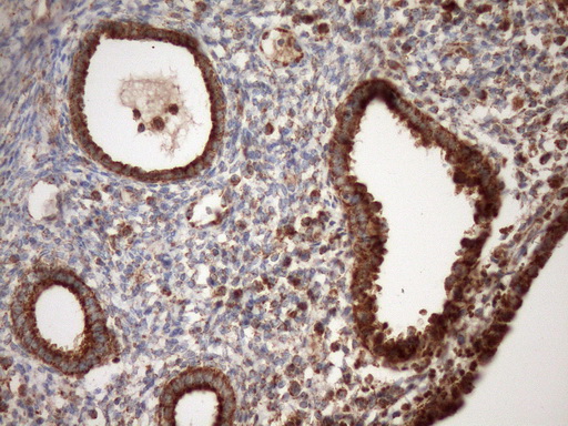 STOML2 Antibody - Immunohistochemical staining of paraffin-embedded Carcinoma of Human pancreas tissue using anti-STOML2 mouse monoclonal antibody. (Heat-induced epitope retrieval by Tris-EDTA, pH8.0)(1:150)