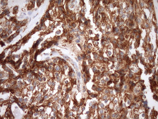 STOML2 Antibody - Immunohistochemical staining of paraffin-embedded Adenocarcinoma of Human breast tissue using anti-STOML2 mouse monoclonal antibody. (Heat-induced epitope retrieval by Tris-EDTA, pH8.0)(1:150)
