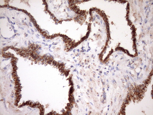 STOML2 Antibody - Immunohistochemical staining of paraffin-embedded Carcinoma of Human prostate tissue using anti-STOML2 mouse monoclonal antibody. (Heat-induced epitope retrieval by Tris-EDTA, pH8.0)(1:150)