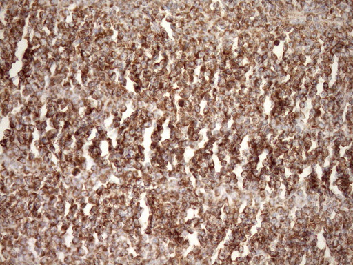 STOML2 Antibody - Immunohistochemical staining of paraffin-embedded Human lymphoma tissue using anti-STOML2 mouse monoclonal antibody. (Heat-induced epitope retrieval by Tris-EDTA, pH8.0)(1:150)