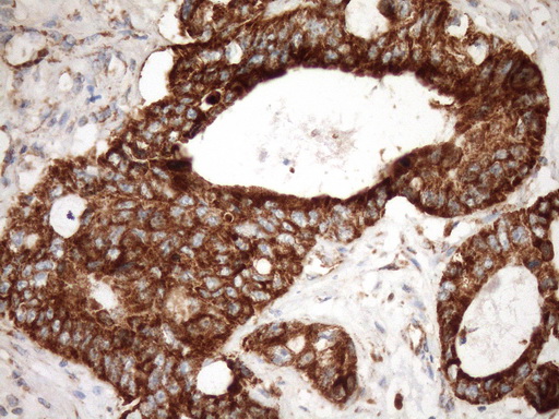STOML2 Antibody - Immunohistochemical staining of paraffin-embedded Adenocarcinoma of Human colon tissue using anti-STOML2 mouse monoclonal antibody. (Heat-induced epitope retrieval by Tris-EDTA, pH8.0)(1:150)