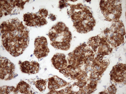 STOML2 Antibody - Immunohistochemical staining of paraffin-embedded Carcinoma of Human liver tissue using anti-STOML2 mouse monoclonal antibody. (Heat-induced epitope retrieval by Tris-EDTA, pH8.0)(1:150)