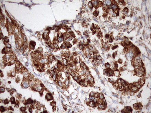 STOML2 Antibody - IHC of paraffin-embedded Adenocarcinoma of Human endometrium tissue using anti-STOML2 mouse monoclonal antibody. (Heat-induced epitope retrieval by Tris-EDTA, pH8.0)(1:150).