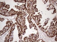 STOML2 Antibody - Immunohistochemical staining of paraffin-embedded Adenocarcinoma of Human ovary tissue using anti-STOML2 mouse monoclonal antibody. (Heat-induced epitope retrieval by 1mM EDTA in 10mM Tris buffer. (pH8.5) at 120°C for 3 min. (1:150)
