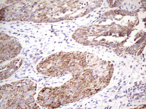 STOML2 Antibody - Immunohistochemical staining of paraffin-embedded Carcinoma of Human bladder tissue using anti-STOML2 mouse monoclonal antibody. (Heat-induced epitope retrieval by 1mM EDTA in 10mM Tris buffer. (pH8.5) at 120°C for 3 min. (1:150)