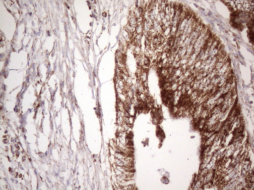 STOML2 Antibody - Immunohistochemical staining of paraffin-embedded Adenocarcinoma of Human colon tissue using anti-STOML2 mouse monoclonal antibody. (Heat-induced epitope retrieval by 1mM EDTA in 10mM Tris buffer. (pH8.5) at 120°C for 3 min. (1:150)