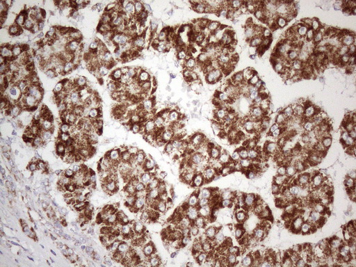 STOML2 Antibody - Immunohistochemical staining of paraffin-embedded Carcinoma of Human liver tissue using anti-STOML2 mouse monoclonal antibody. (Heat-induced epitope retrieval by 1mM EDTA in 10mM Tris buffer. (pH8.5) at 120°C for 3 min. (1:150)
