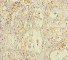 STOML2 Antibody - Immunohistochemistry of paraffin-embedded human lung cancer at dilution of 1:100