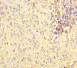 STOML2 Antibody - Immunohistochemistry of paraffin-embedded human melanoma cancer at dilution of 1:100