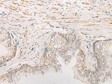 STOML2 Antibody - Immunohistochemistry of paraffin-embedded Human prost at e cancer tissue  using STOML2 Polyclonal Antibody at dilution of 1:25(×200)