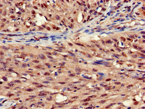 STOML3 Antibody - Immunohistochemistry of paraffin-embedded human lung cancer at dilution of 1:100