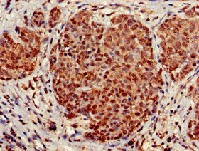 STOML3 Antibody - Immunohistochemistry of paraffin-embedded human ovarian cancer at dilution of 1:100