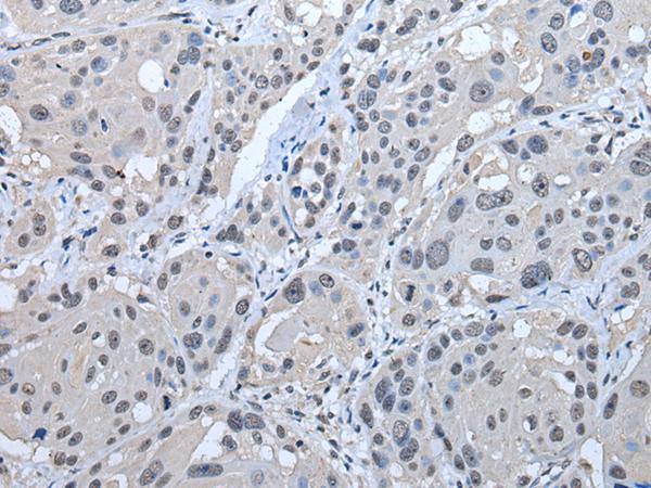 STRADA / LYK5 Antibody - Immunohistochemistry of paraffin-embedded Human esophagus cancer tissue  using STRADA Polyclonal Antibody at dilution of 1:45(×200)